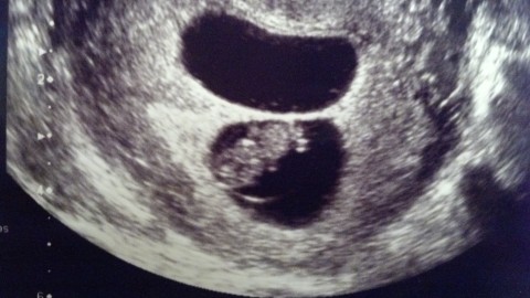 Baby B: 8 weeks, 4 days